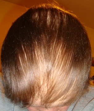 Perte de Cheveux - Alopécie Congénitale - Om Signature Clinique Médico-Esthétique